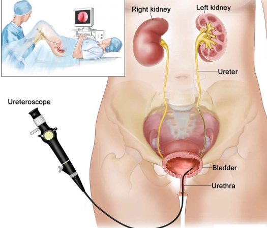 cirurgia calculo renal